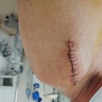 Broken arm leads to evidence of secret antipsychotic hidden as baby aspirin!